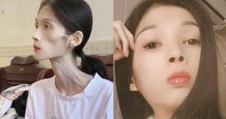 Hình ảnh Kiều Kiều hiện tại (trái) và thời còn khỏe mạnh.