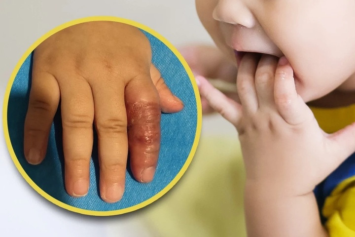 Ngón trỏ của bé Lele bị sưng và đổi màu do mẹ quấn băng. (Ảnh: Sina)