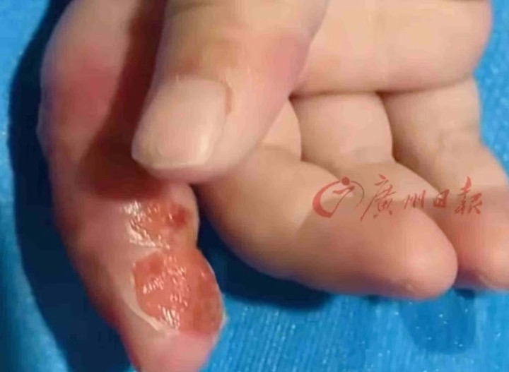Một phần da và mô ở ngón trỏ của Lele đã hoại tử. (Ảnh: Sina)