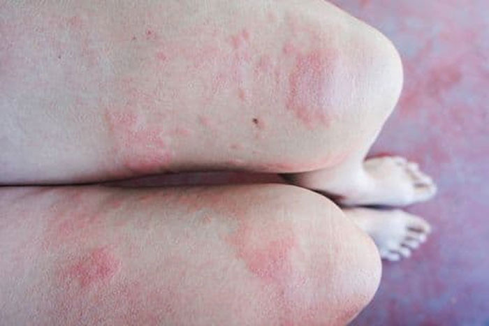 Tại sao ngày càng nhiều người mắc giang mai Cảnh báo Ngoài quan hệ tình dục nguy cơ cao 3 hành vi cần được kiểm soát