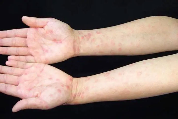 Tại sao ngày càng nhiều người mắc giang mai Cảnh báo Ngoài quan hệ tình dục nguy cơ cao 3 hành vi cần được kiểm soát