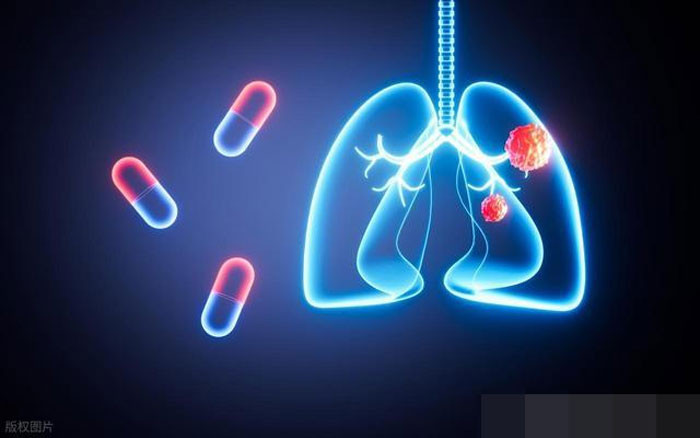 Bác sĩ cảnh báo Dấu hiệu sớm của ung thư phổi không phải đau ngực mà là 5 triệu chứng bất thường này nhiều người bỏ qua