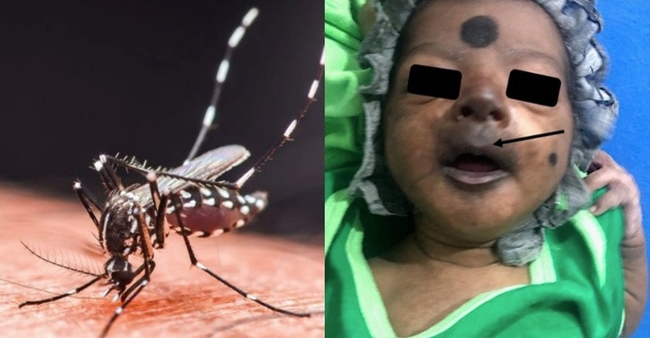 Bé sơ sinh mặt tím đen, phải nhập viện cấp cứu khẩn cấp vì Chikungunya. (Ảnh: Clinical Case Reports)