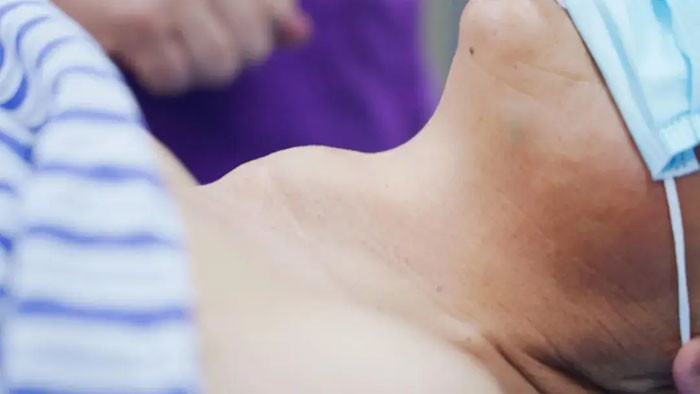 5 biểu hiện sau khi ngủ dậy có thể là dấu hiệu ung thư tuyến giáp biết sớm vẫn chưa muộn