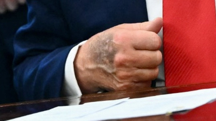 Vết bầm gây chú ý trên tay ông Trump.