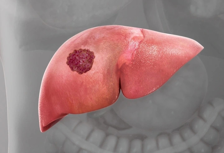 loai ung thu gay tu vong hang dau tai viet nam lieu co chua khoi hinh anh 1