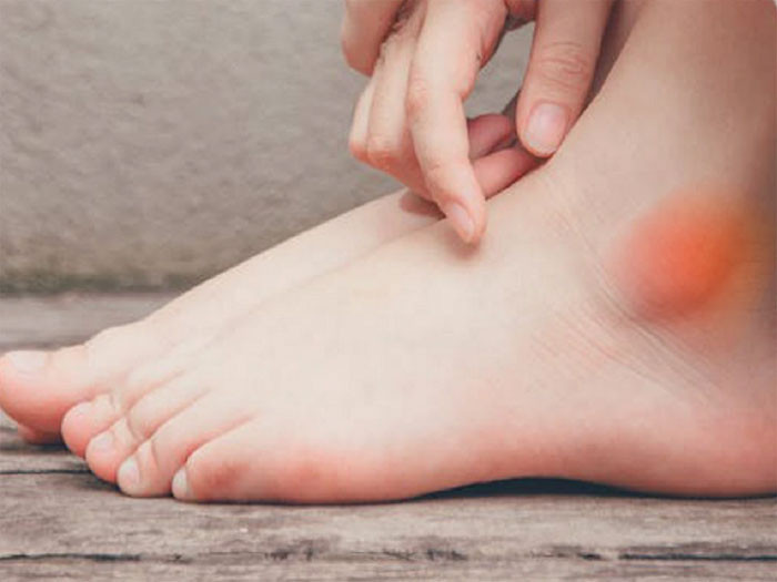 Nếu có ba bất thường ở bàn chân khả năng cao gan thận có vấn đề Khám càng sớm càng tốt