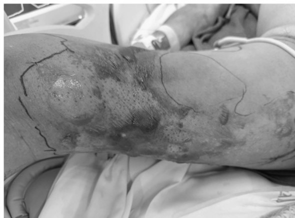 Người đàn ông 59 tuổi hoại tử nặng vùng đùi, rơi vào nguy kịch sau khi đi tắm biển - Ảnh 1.