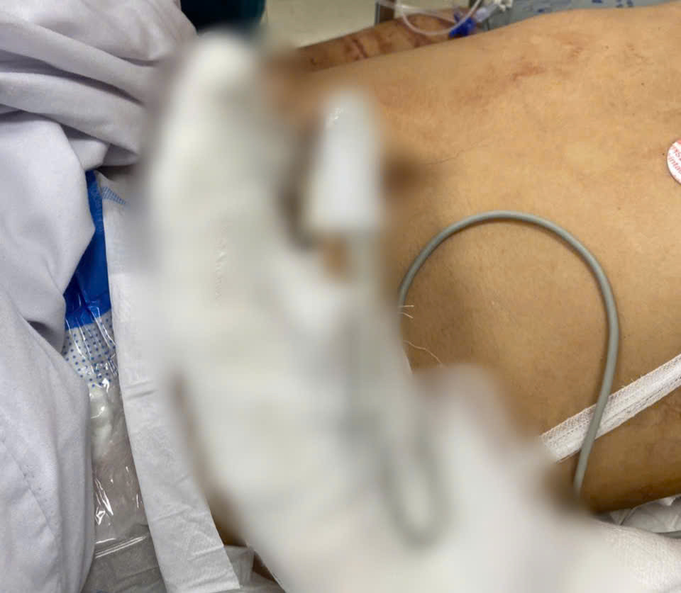 Đang ngồi trong nhà hút thuốc, người đàn ông bị kẻ lạ mặt xông vào chém đứt lìa tay- Ảnh 2.