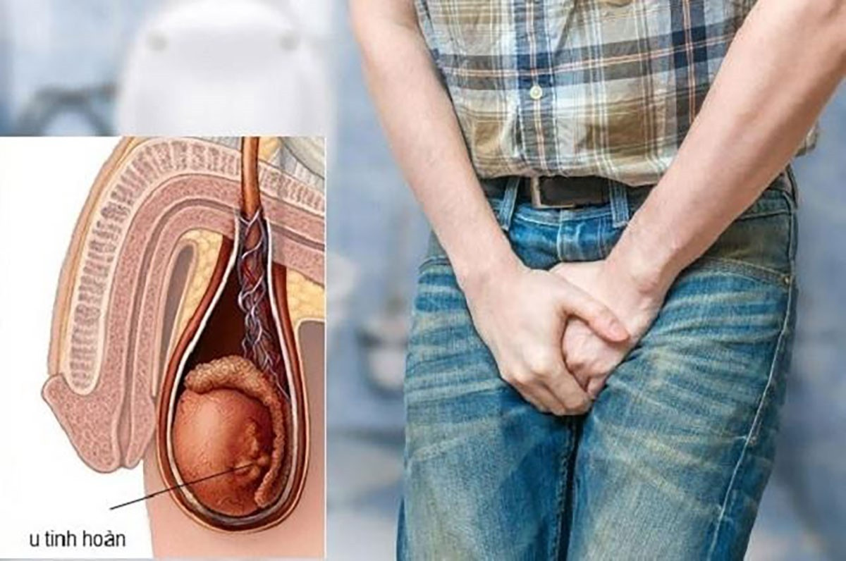 Người đàn ông 60 tuổi phát hiện ung thư tinh hoàn từ dấu hiệu nhiều nam giới Việt bỏ qua- Ảnh 1.