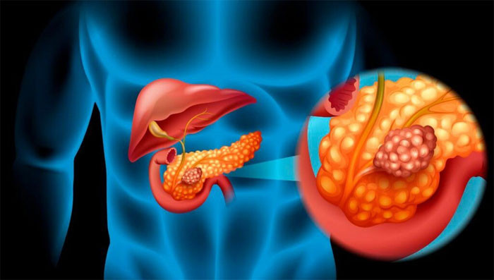 4 dấu hiệu bất thường cảnh giác với ung thư tuyến tụy