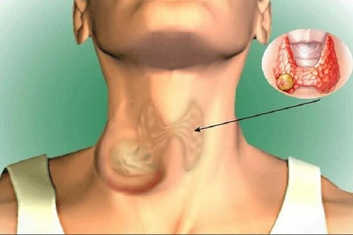Ung thư tuyến giáp thể nhú là loại phổ biến nhất.