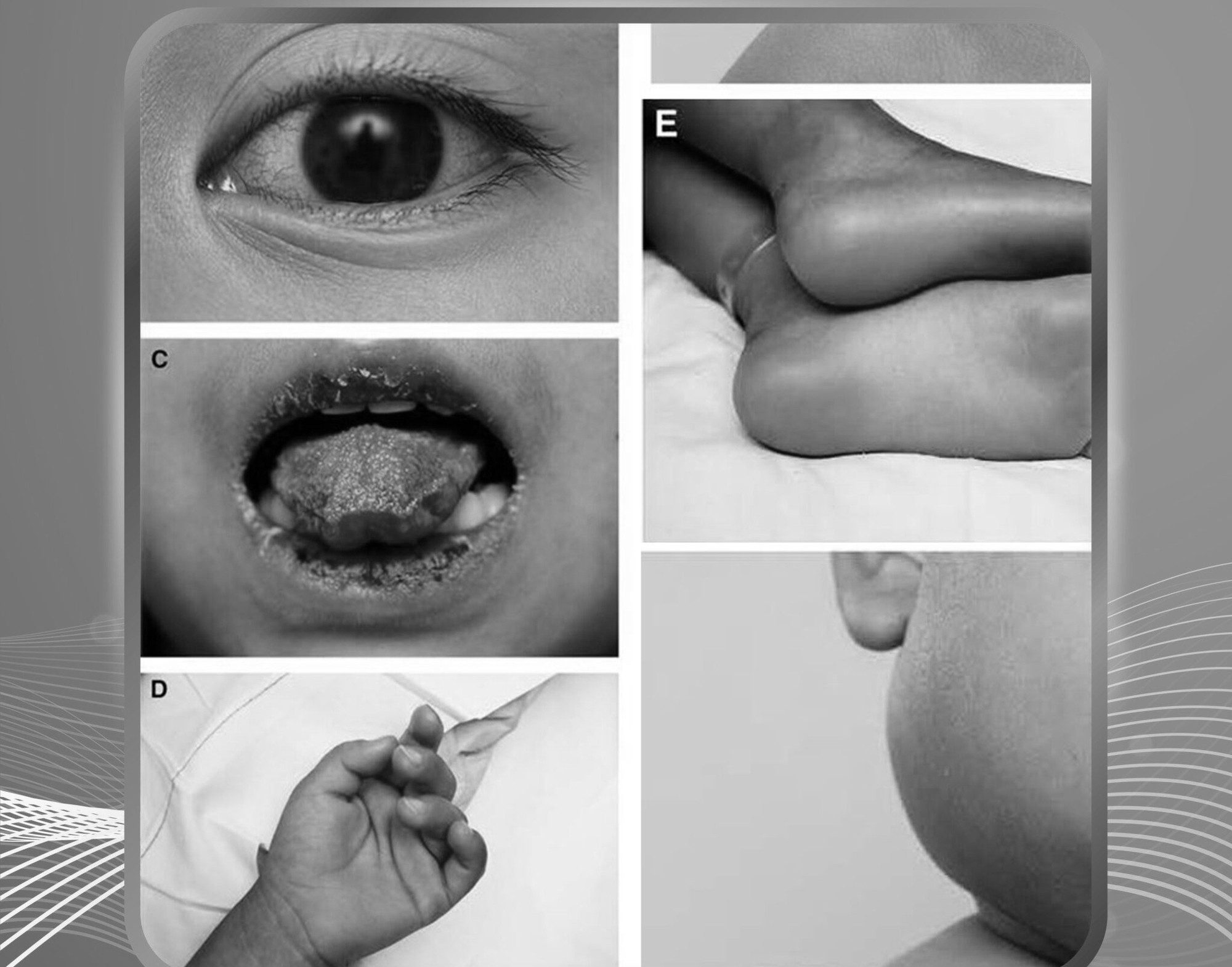 Sốt cao nhiều ngày, bé 5 tuổi đi khám phát hiệm bệnh hiếm gặp - Ảnh 1.