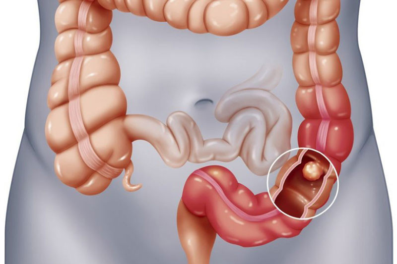 Nếu có polyp trong ruột sẽ có hai dấu hiệu khi đi vệ sinh Đừng đợi đến giai đoạn cuối mới phản ứng