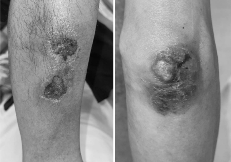 Dùng thuốc điều trị bệnh ngoài da sai chỉ định, người đàn ông ngộ độc, nguy cơ nhiễm trùng toàn thân - Ảnh 1.