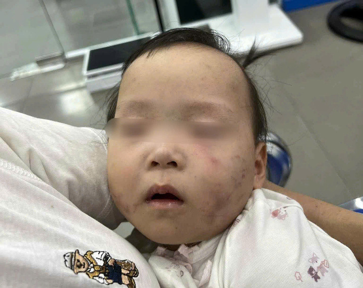 Cháu Dương Tú V. bị bầm tím mặt khi gửi tại cơ sở giáo dục mầm non tư thục Mùa Xuân – cơ sở 1.