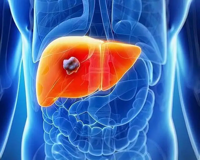 Từ viêm gan đến ung thư gan lá gan của bạn đã trải qua những gì 3 thói quen dễ mắc bệnh nhất