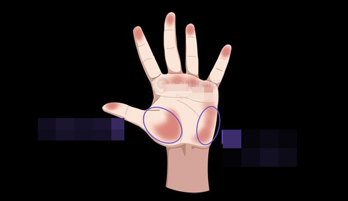 5 thay đổi trên bàn tay cảnh báo ung thư