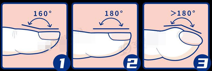 5 thay đổi trên bàn tay cảnh báo ung thư