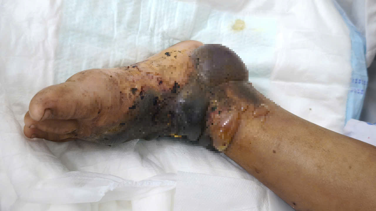 Tự chữa thuốc nam, bé trai 4 tuổi nhập viện vì hoại tử chân - Ảnh 2.