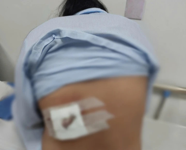 Người phụ nữ bị hoại tử vùng lưng, nhiễm trùng nặng sau khi tự ý dừng thuốc kháng sinh, đắp lá điều trị mụn nhọt.