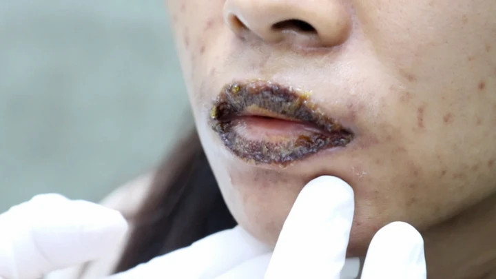 Bệnh nhân nhập viện vì biến chứng sau khi khử thâm môi.