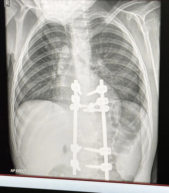Kết quả X-quang của Elliot sau phẫu thuật. (Ảnh: Kennedy News)