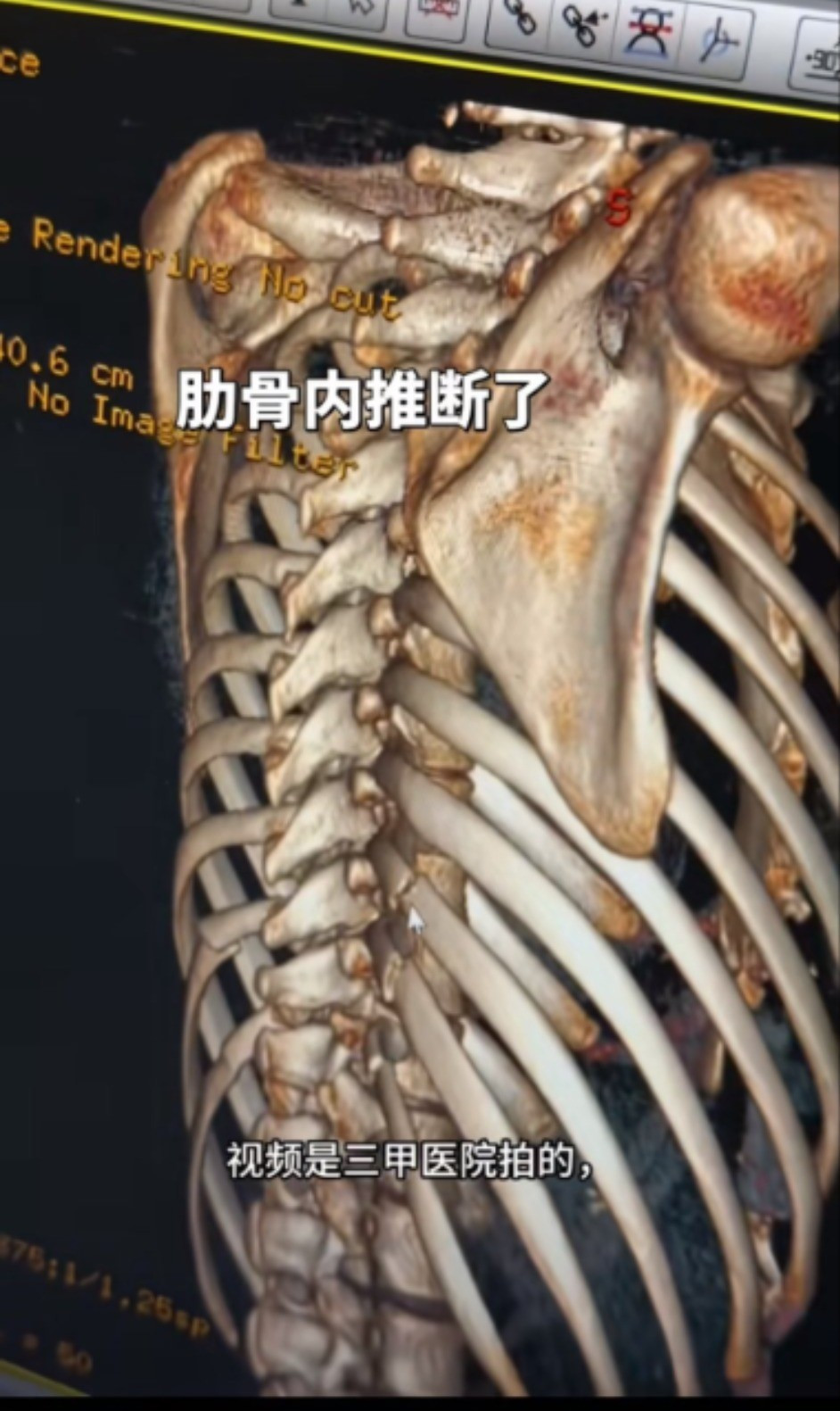 Xu hướng bẻ xương sườn để có vòng eo con kiến插图2 x21-1740.jpg