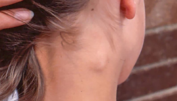 3 bất thường ở cổ cảnh báo ung thư, hãy đi khám bác sĩ ngay lập tức插图 Xuất hiện khối u hoặc hạch bất thường ở cổ, cần lưu ý.