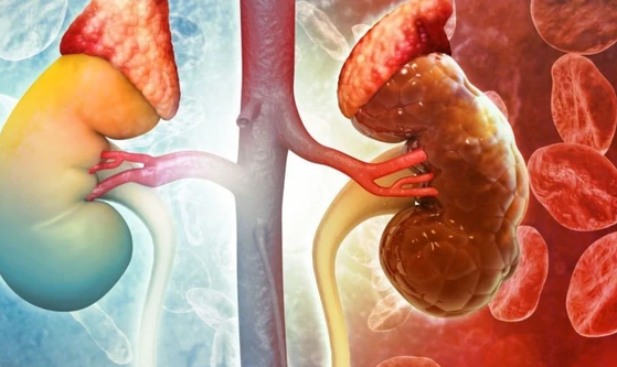 Thanh niên 30 tuổi đang khỏe mạnh sững sờ phát hiện suy thận: 'Tôi không hề đau, không mệt, sinh hoạt bình thường' - Ảnh 1.