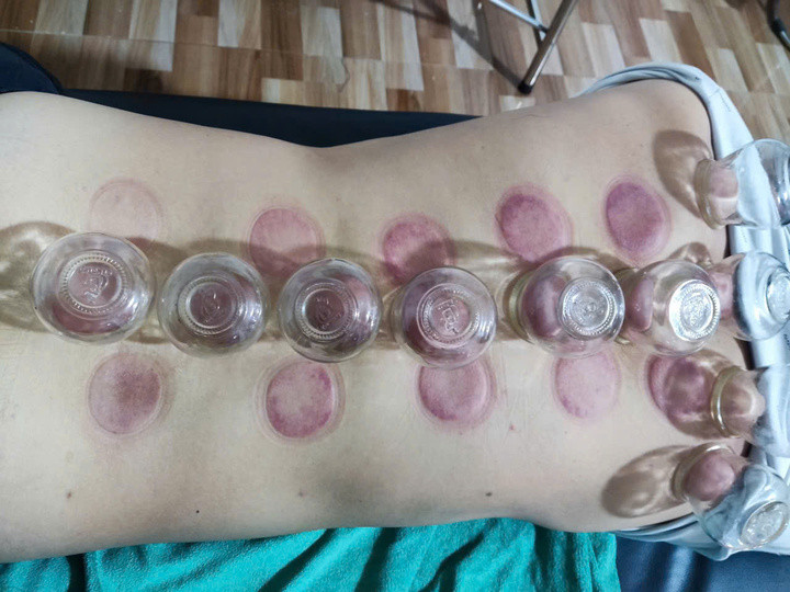 Bệnh nhân được điều trị bằng phương pháp giác hơi. (Ảnh: Huy Khước)