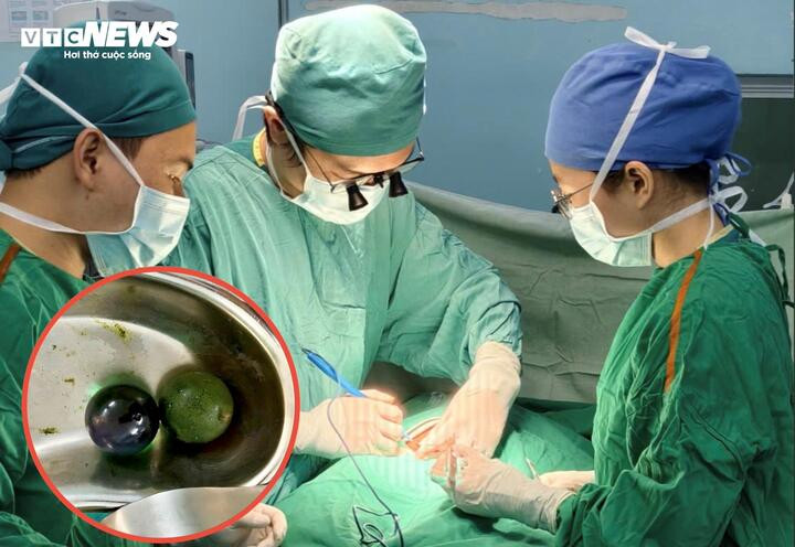 Bé gái 18 tháng tuổi nguy kịch, ruột tắc nghẽn vì nuốt hạt nở đồ chơi插图 Ê-kíp thực hiện phẫu thuật mở ruột lấy dị vật cho bé gái 18 tháng tuổi.