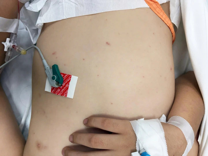 Trường hợp bệnh nhi mắc viêm não mô cầu điều trị tại TP.HCM.