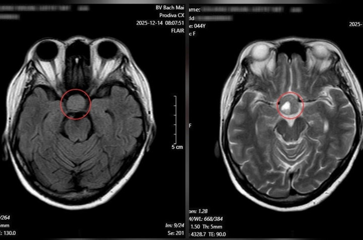 Kết quả chụp cộng hưởng từ (MRI) sọ não cho thấy khối u tuyến yên kích thước lớn.