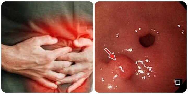 Ung thư dạ dày thường rất khó nhận biết