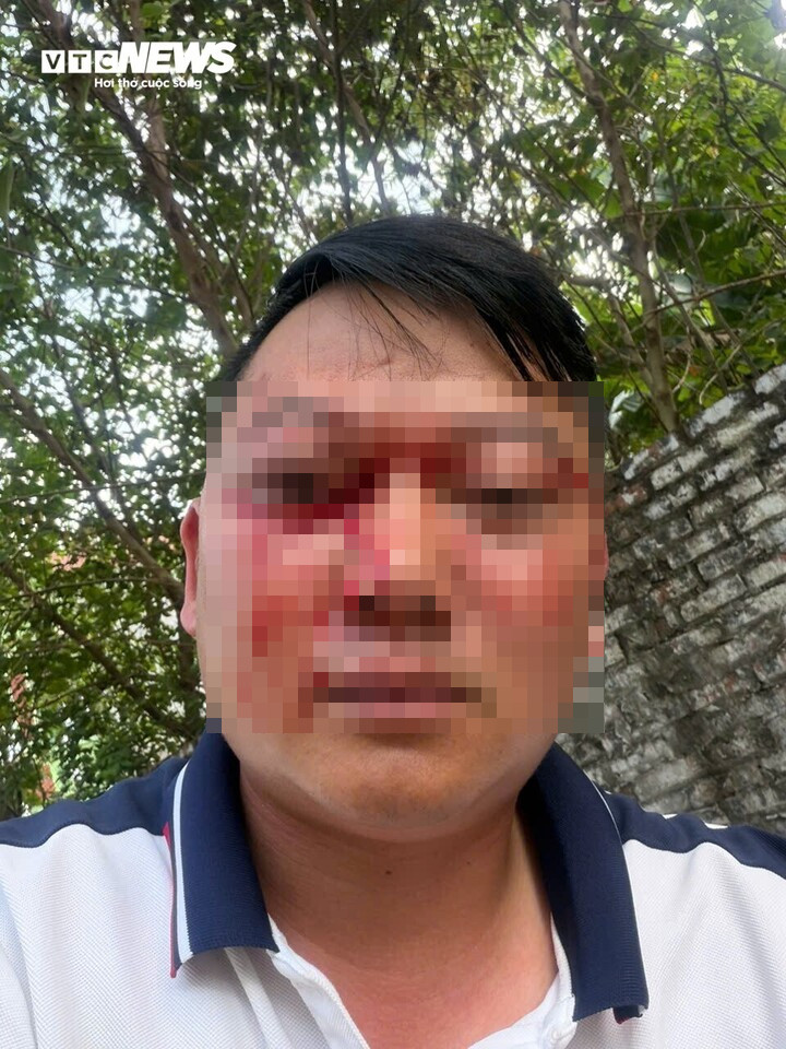Anh Đinh Văn Trọng với nhiều vết thương trên khuôn mặt sau khi bị hành hung. (Ảnh: NVCC)