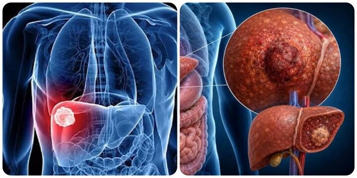 Nhận biết sớm các triệu chứng ung thư gan giúp việc điều trị dễ dàng hơn