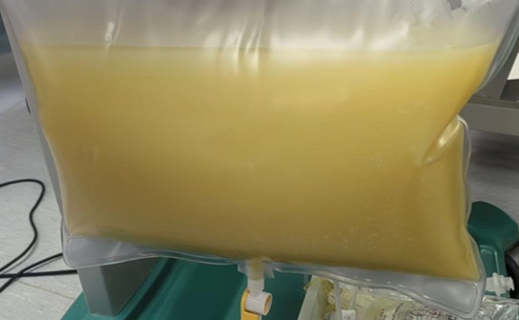 Nam sinh viêm tụy cấp, mỡ máu cao gấp 47 lần thừa nhận một sai lầm nhiều bạn trẻ Việt mắc phải - Ảnh 1.