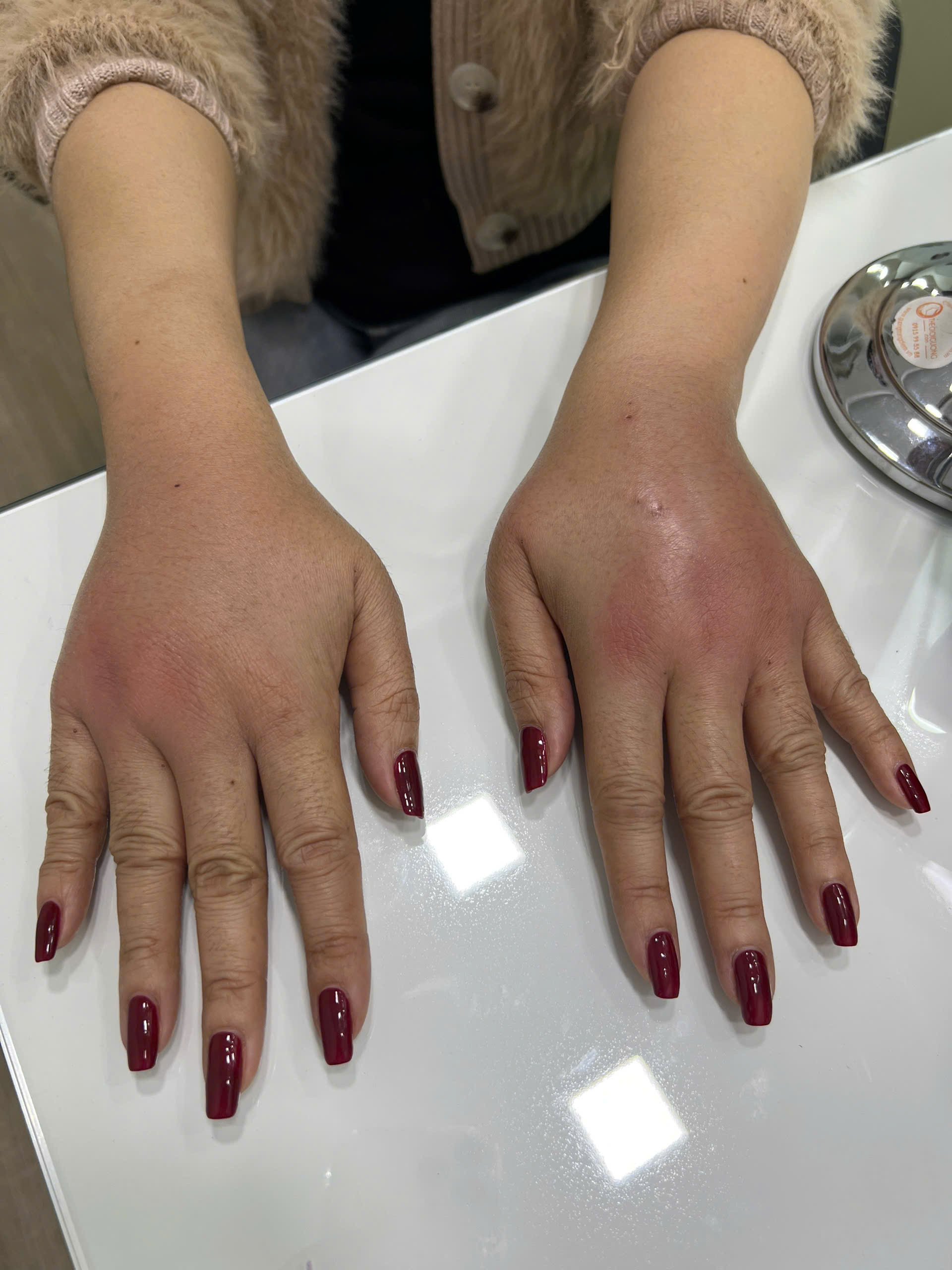 Biến dạng, lệch mặt… vì làm đẹp cấp tốc cận Tết - Ảnh 2.