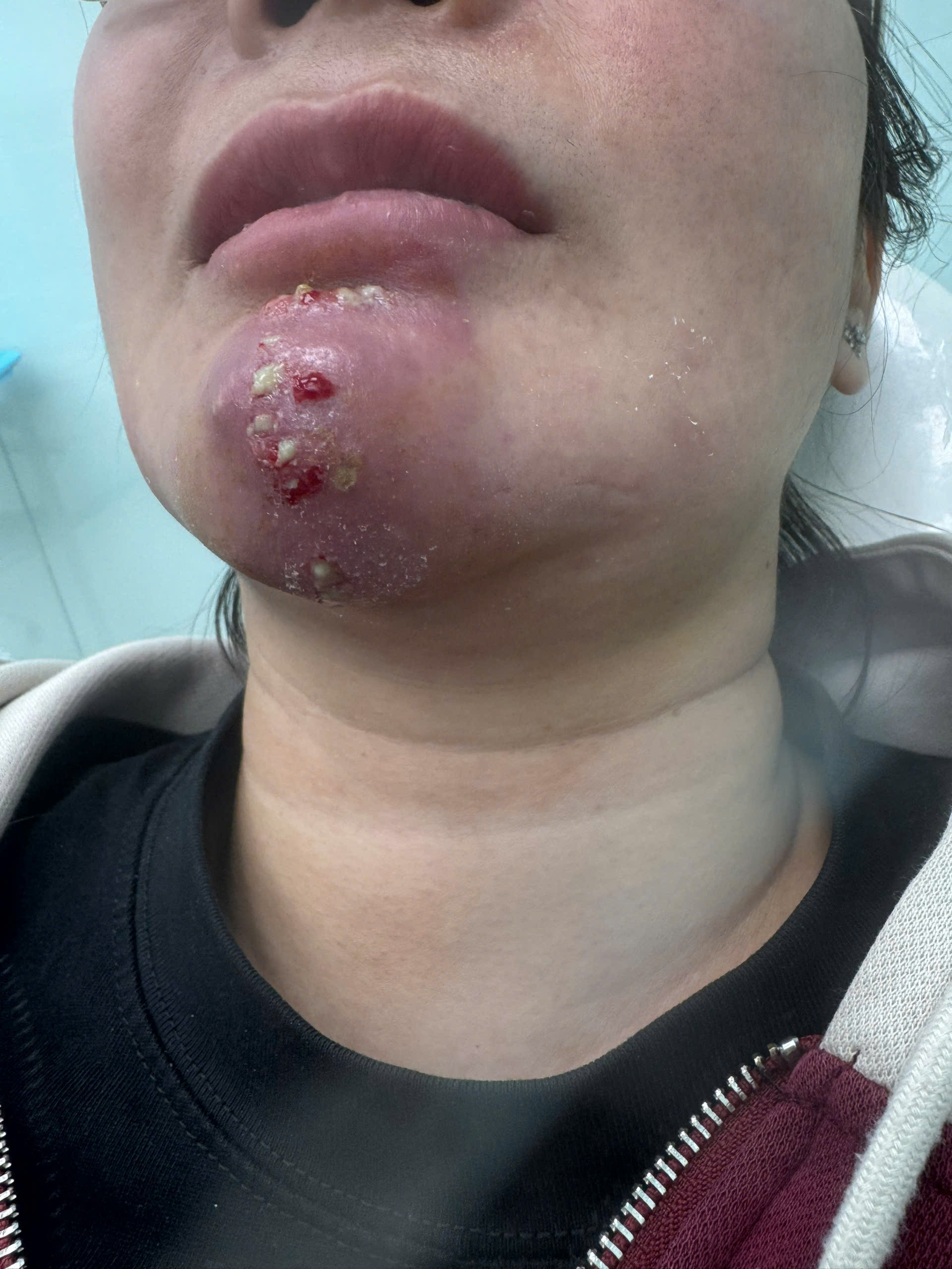 Biến dạng, lệch mặt… vì làm đẹp cấp tốc cận Tết - Ảnh 1.