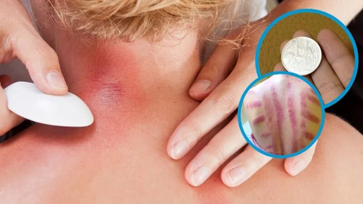 Vì sao đau mỏi người, &amp;apos;trúng gió&amp;apos; dùng đồ bạc, trứng gà để cạo gió?插图