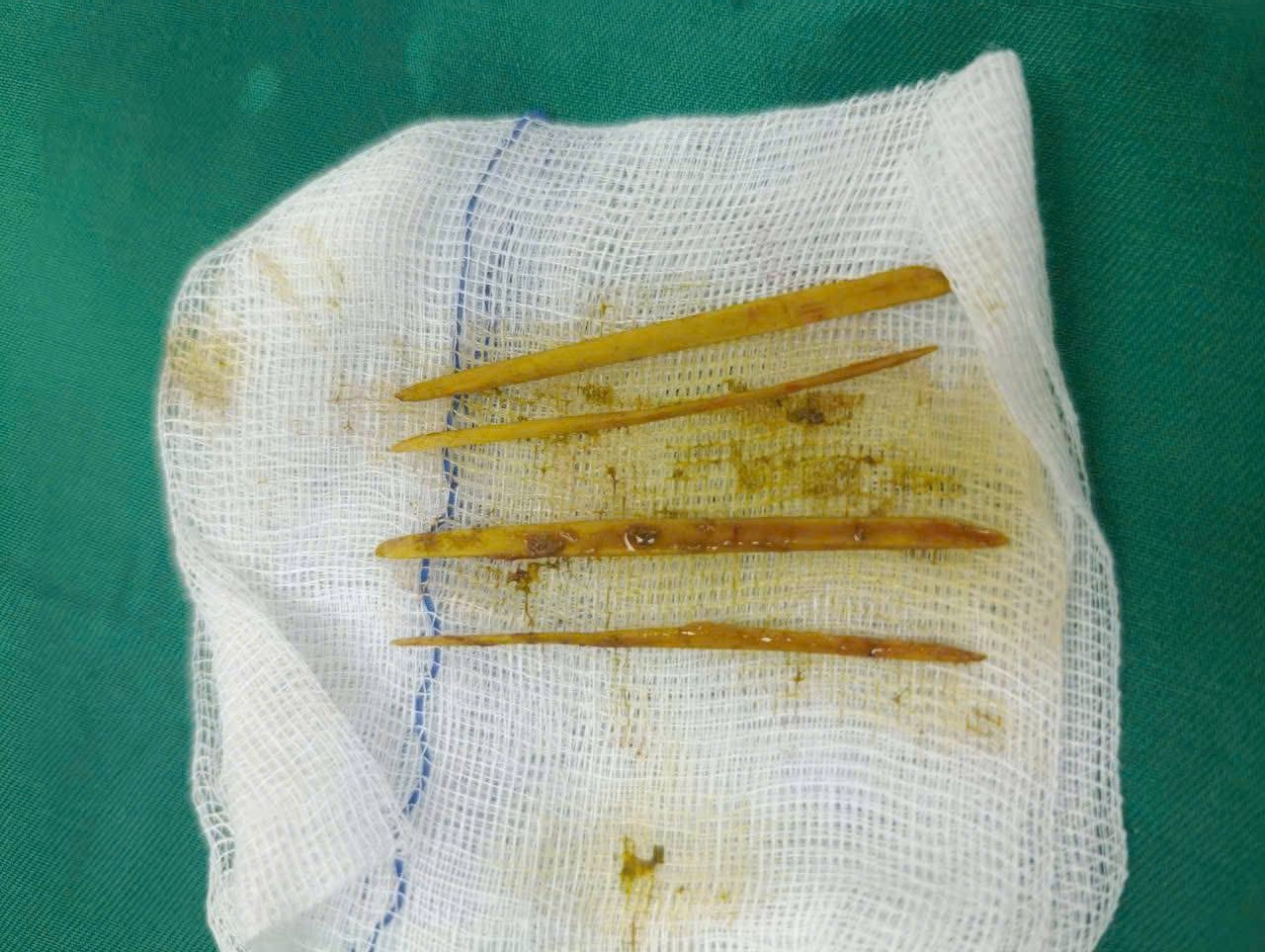 Nuốt tăm khi ăn cỗ cưới, cô gái 26 tuổi nhập viện gấp vì suýt thủng đại tràng - Ảnh 1.