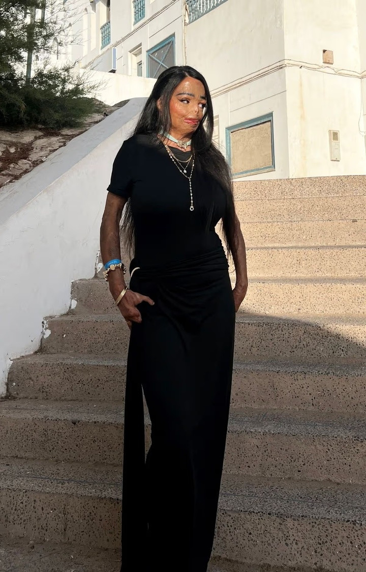 Aleema vẫn còn gặp khó khăn khi làm những công việc cơ bản.