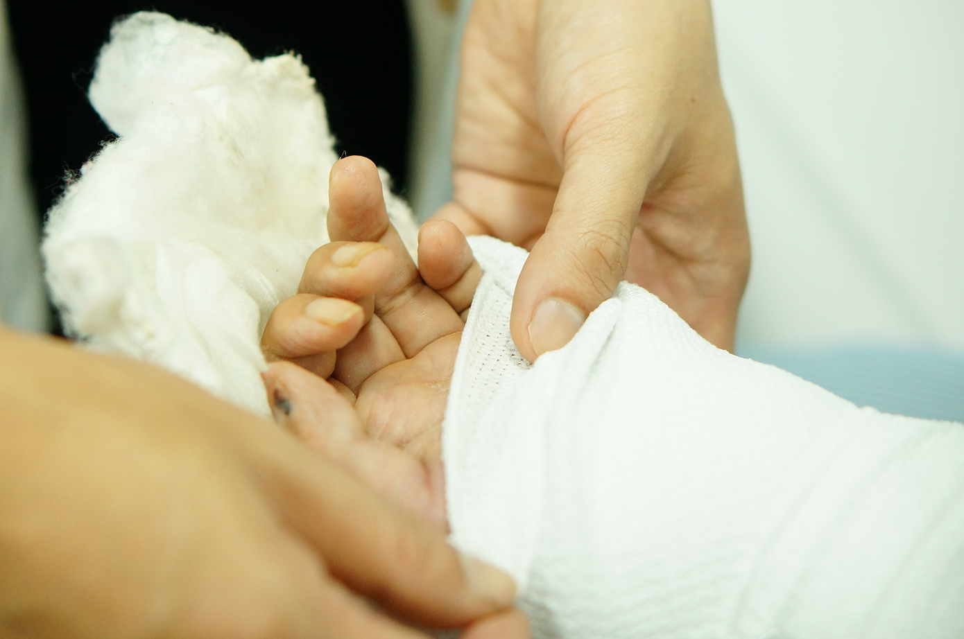 8 giờ vi phẫu nghẹt thở nối lại 4 ngón tay đứt lìa cho người đàn ông插图1 8 giờ vi phẫu nghẹt thở nối lại 4 ngón tay đứt lìa cho người đàn ông插图1