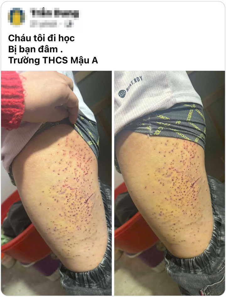 Hình ảnh học sinh ở Lào Cai nghi bị bạn dùng vật nhọn gây thương tích. (Ảnh: T.D.)