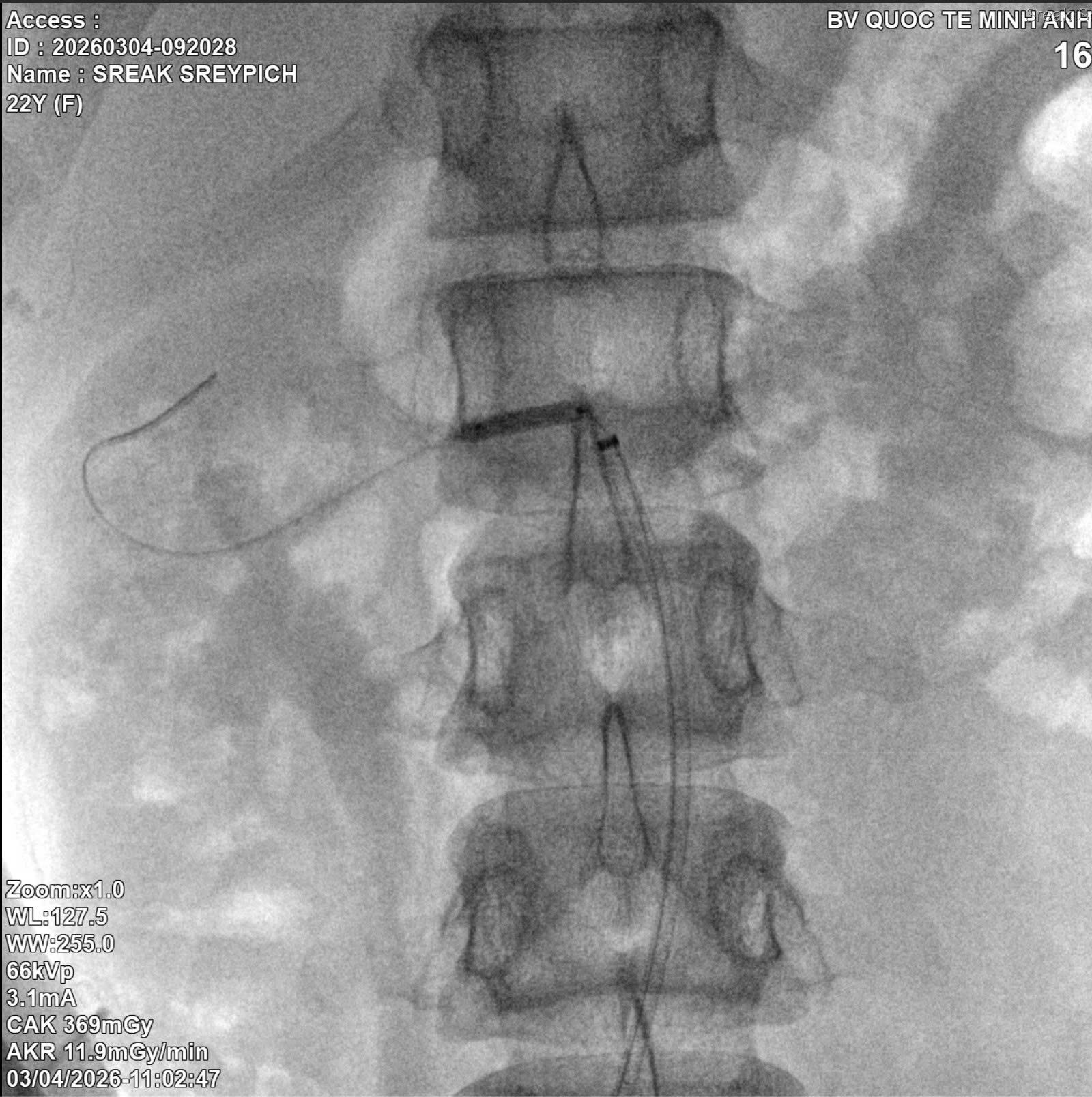 Một nữ sinh suy thận ở tuổi 22, hồi chuông cảnh báo cho người trẻ - Ảnh 2.