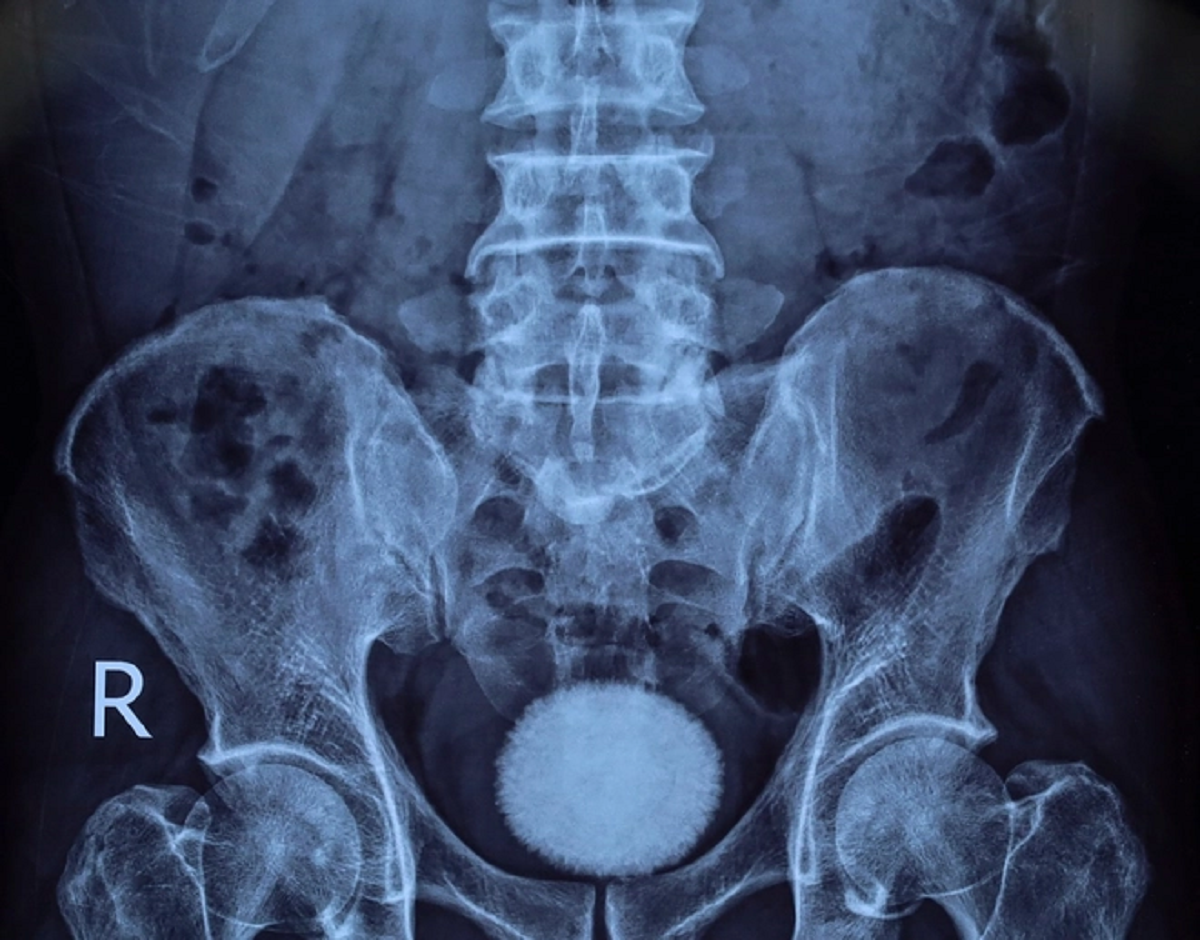 Người đàn ông 50 tuổi đau hạ vị kéo dài, bác sĩ sốc khi gắp ra thứ