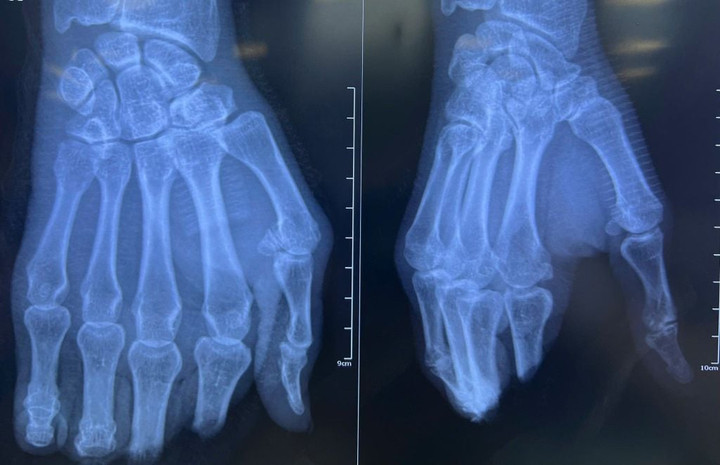 8 giờ vi phẫu nghẹt thở nối lại 4 ngón tay đứt lìa cho người đàn ông插图 Hình chụp X-Quang bàn tay bị đứt lìa 4 ngón của người bệnh. (Ảnh: BVCC)