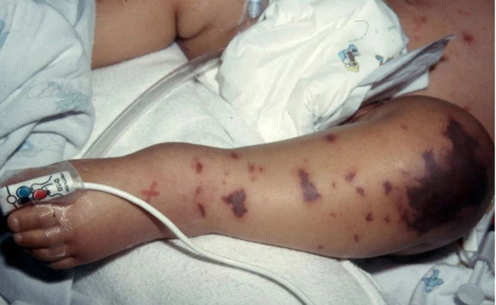 Nhận diện sớm dấu hiệu điển hình của bệnh do não mô cầu để điều trị kịp thời (Ảnh: VOV)