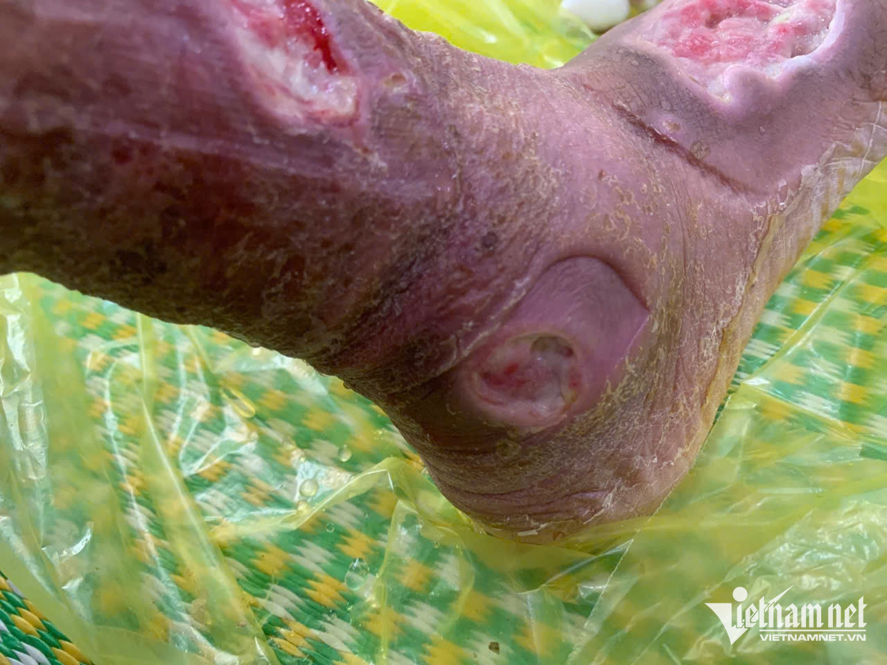 Dẫm phải gai hoa hồng, người phụ nữ ở Vĩnh Phúc đối diện nguy cơ cắt cụt chi插图 W-Ban chan .jpeg